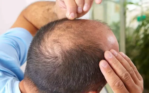 دراسة تكشف مفاجأة.. الصلع المبكر قد يقلل خطر الإصابة بسرطان البروستاتا